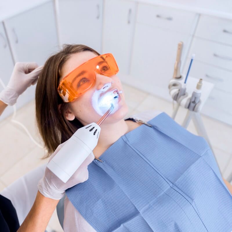 A rendelői fogfehérítés a fog fehérítés egyik bevett módszere