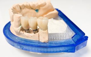 1 db fogpótlás ára gyakori kérdések