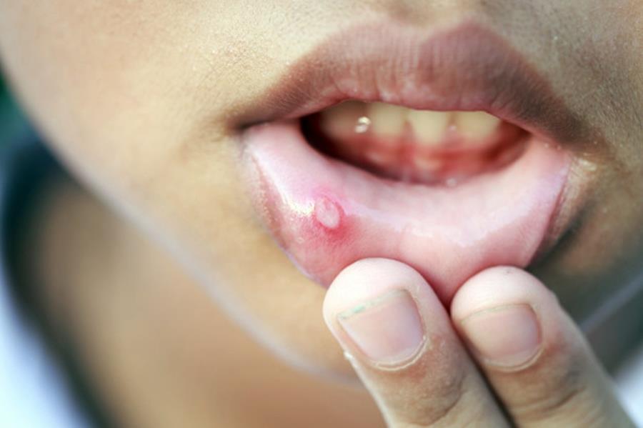 Afta a szájban? A szájüregi fekély, vagyis az afta kezelése házilag is lehetséges.