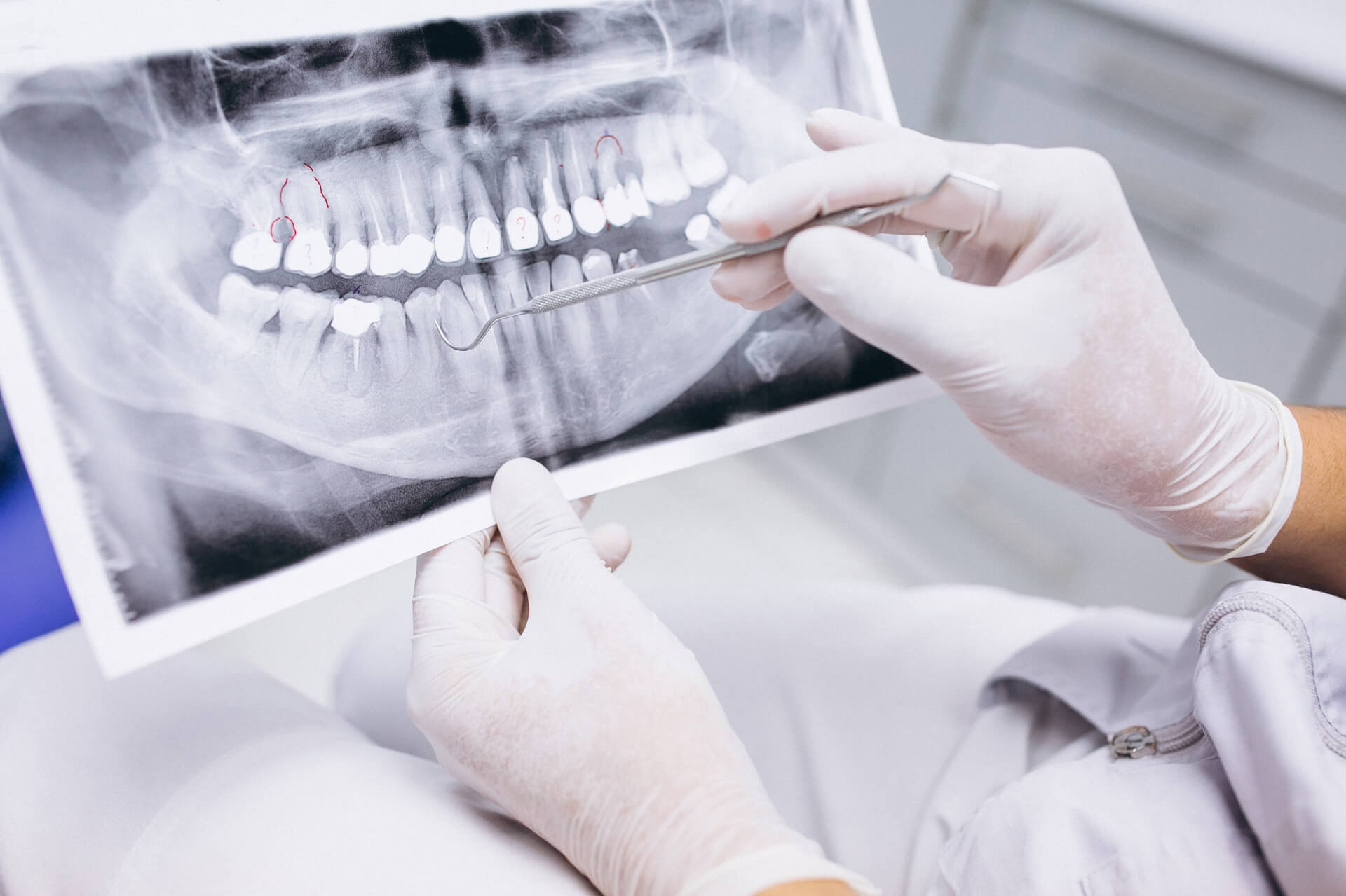 elhalt fog röntgenképe - ezt okozhatja a fogciszta