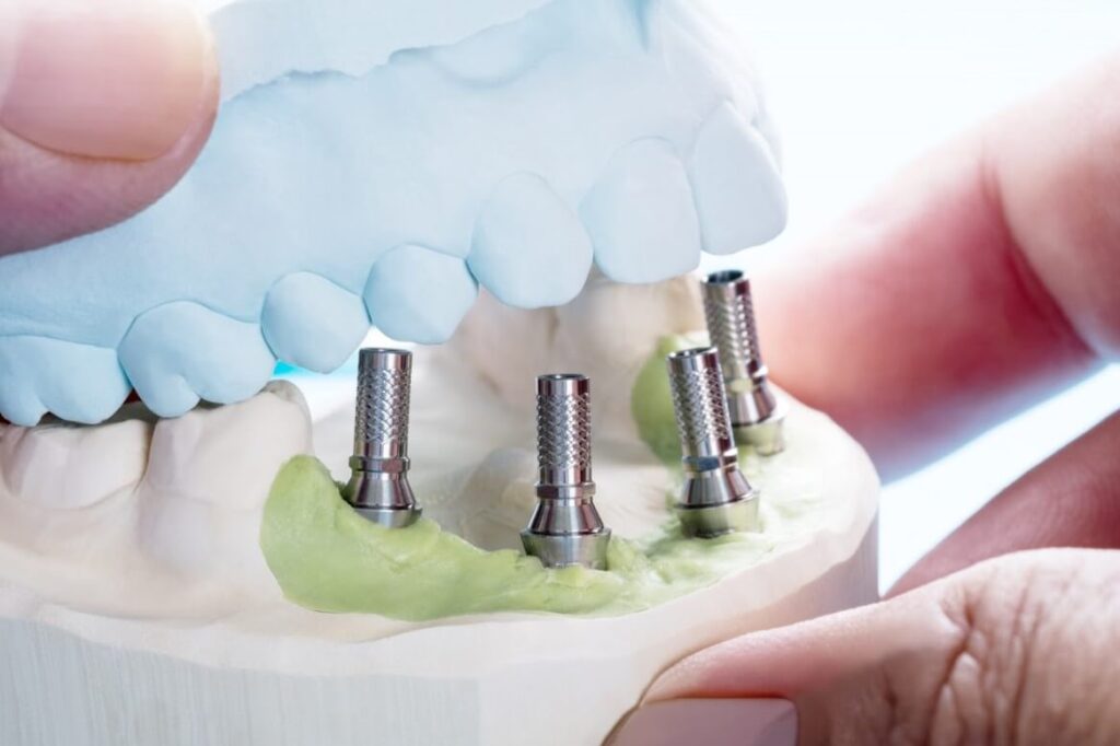 fog implantátum: mennyire fájdalmas a fogimplantáció?