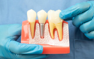 Az elrontott fog implantátum kezelése.