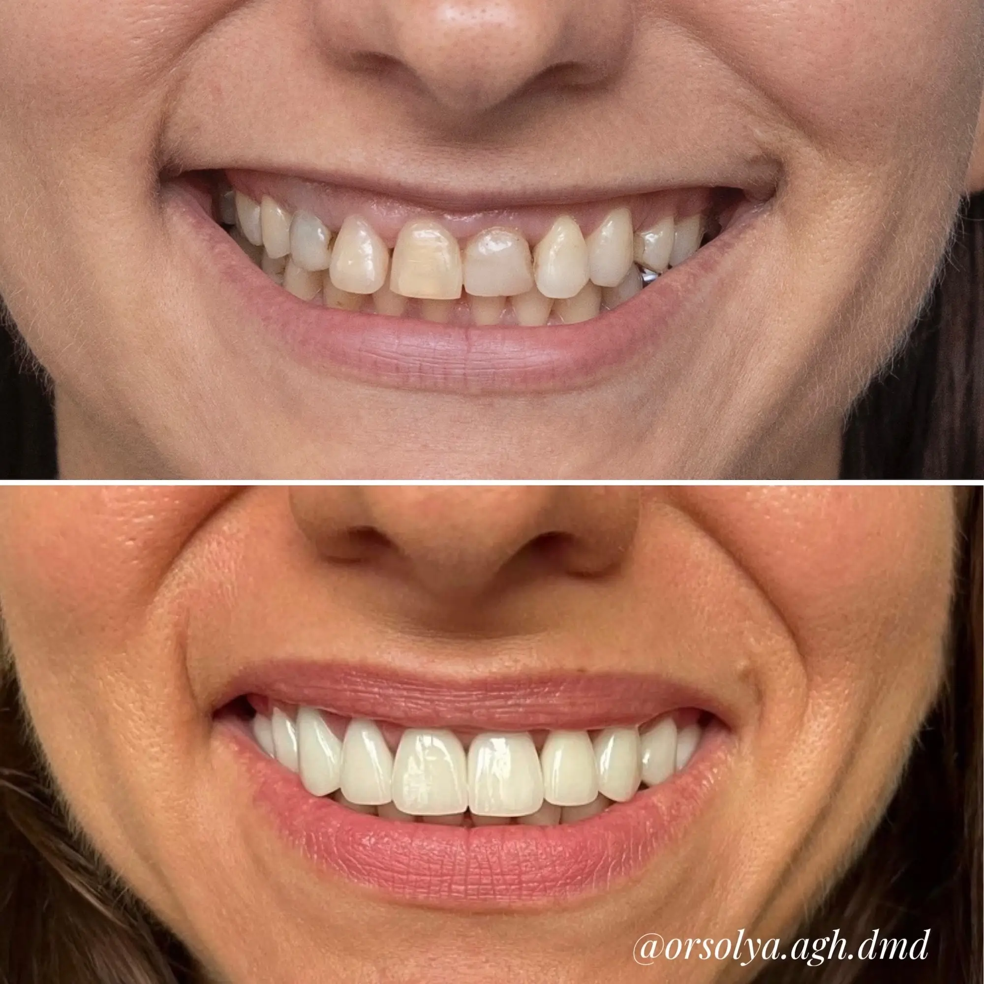 elotte-utana-fogsor-1