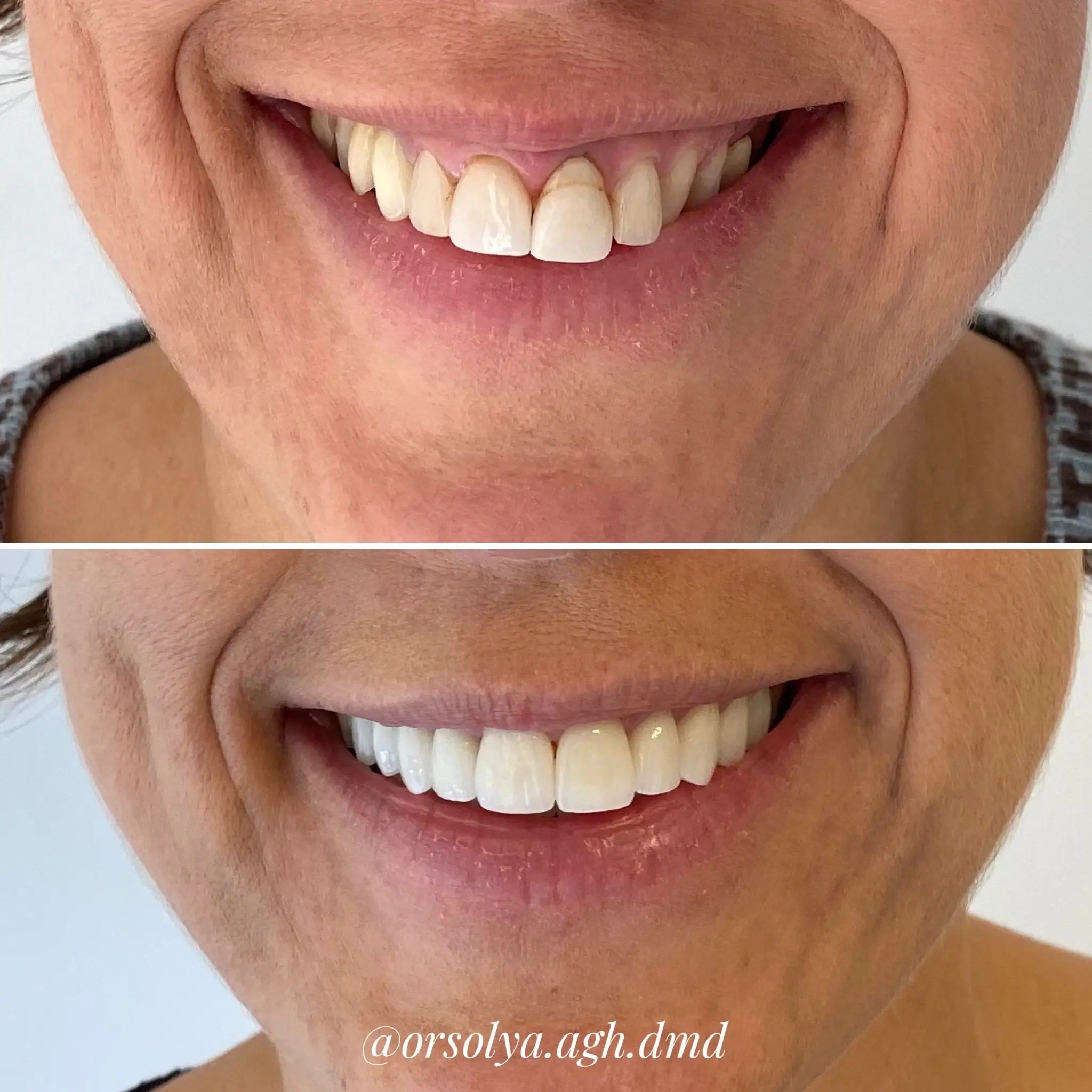 elotte-utana-fogsor-2