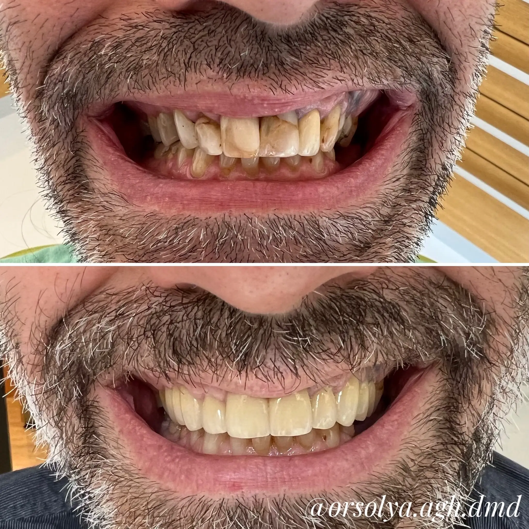 elotte-utana-fogsor-3