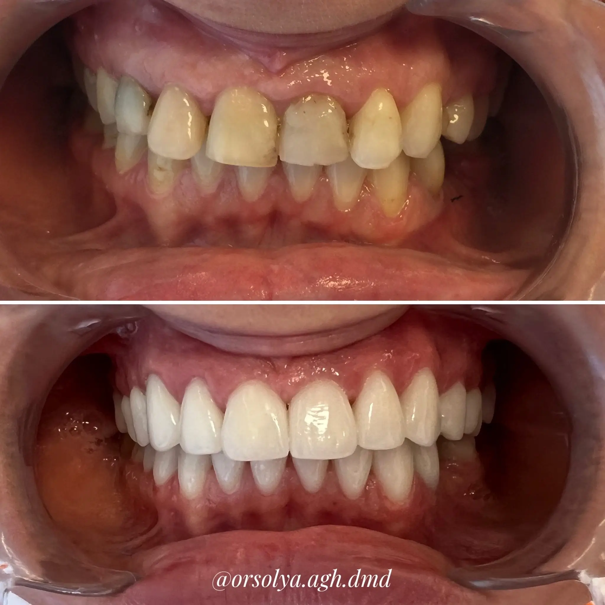 elotte-utana-fogsor-4